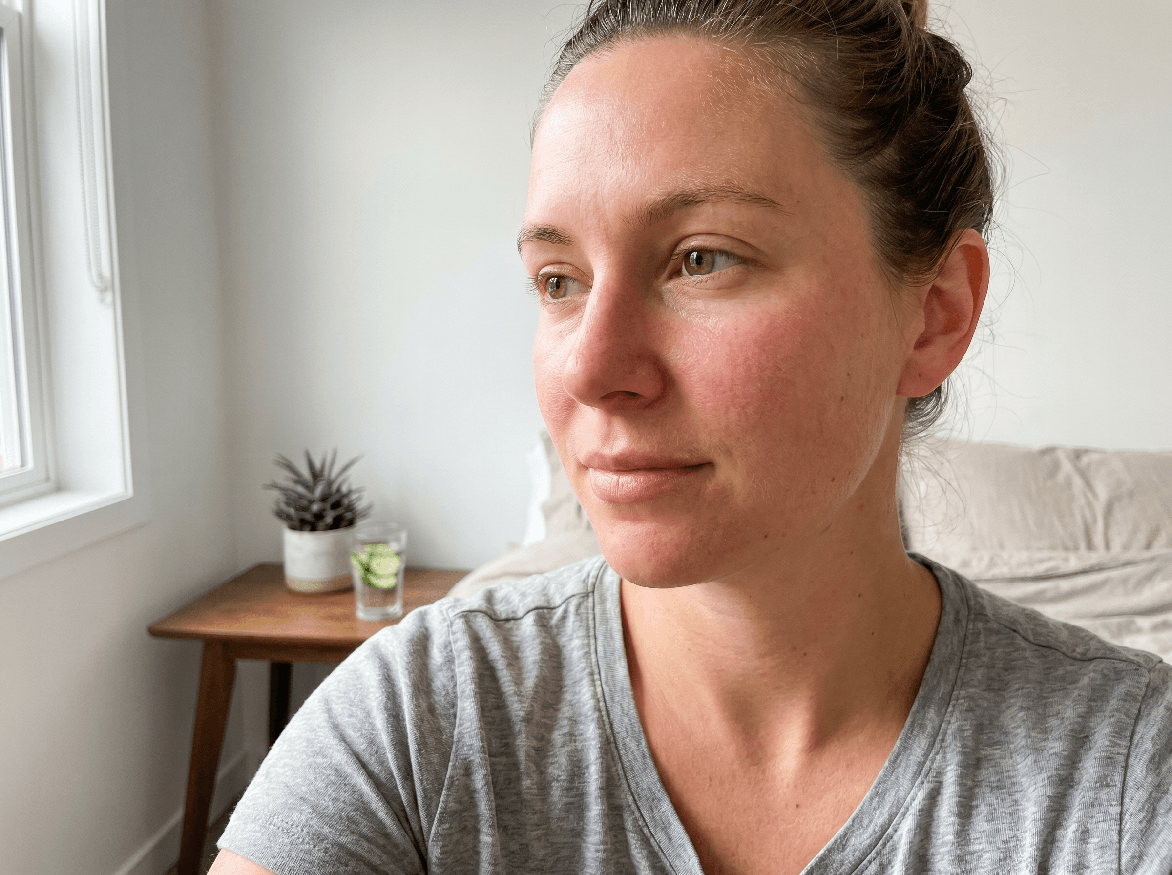 Skin Texture before — Microneedling + Growth Factors