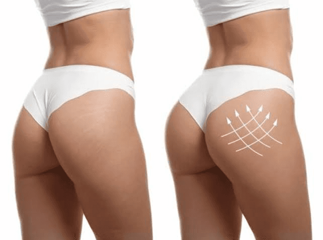 How Does Butt Filler Work?