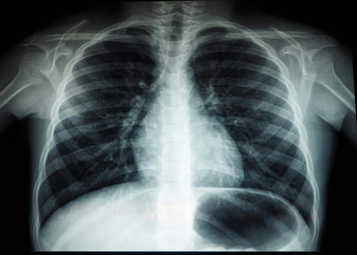 X-ray of a person's chest showing lungs, heart, and thymus