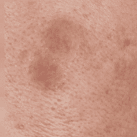 검은 색소와 파인 부분을 채워야 함. 레이저와 쥬베룩 조합 |  홍대 뷰티스톤