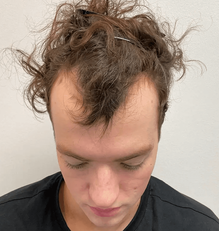 Before hair transplant – Rory's FUE Hair Transplant