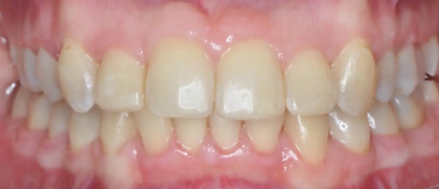 Prima e dopo il trattamento ortodontico funzionale, senza estrazione dei denti premolari