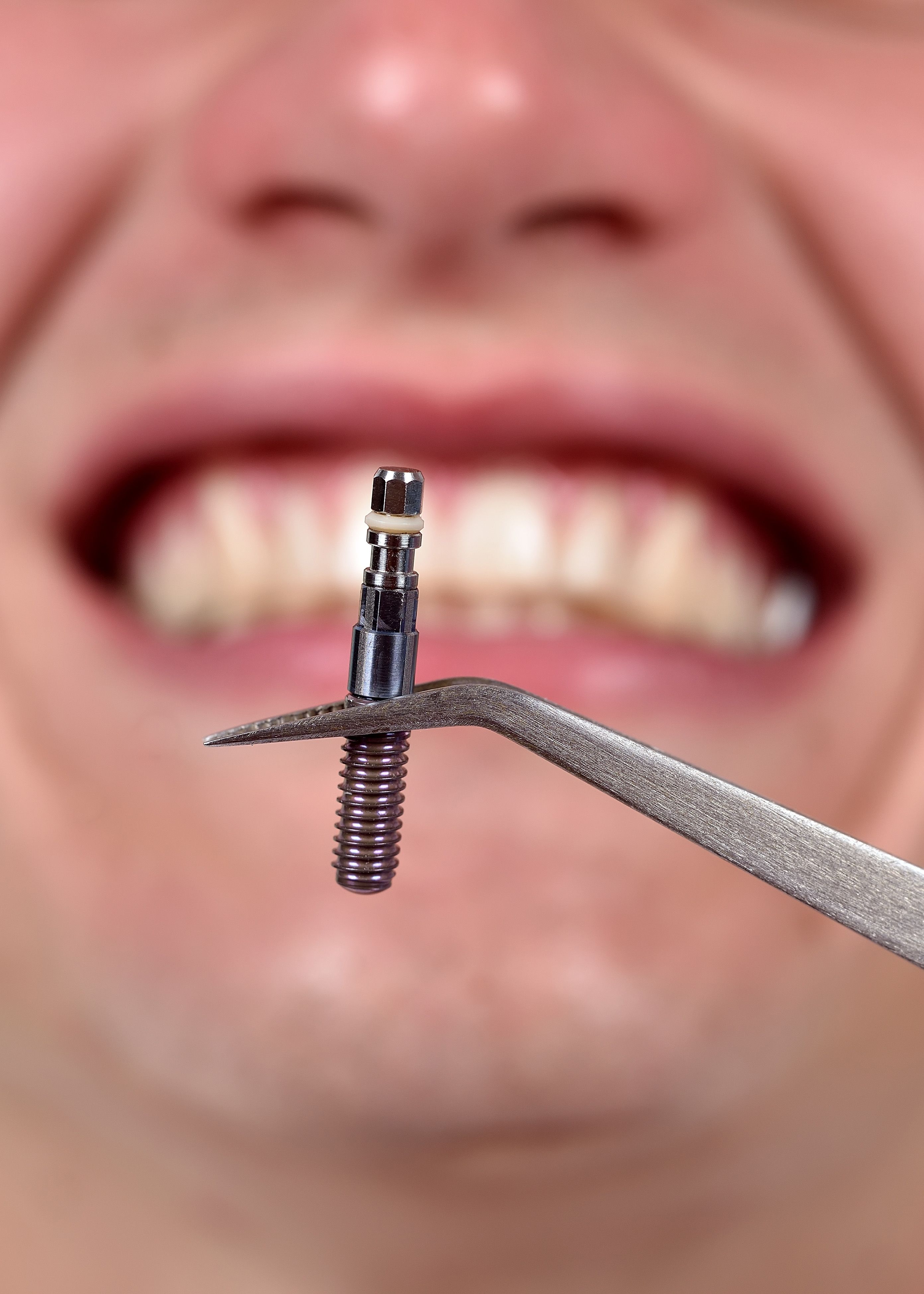 failed dental implant