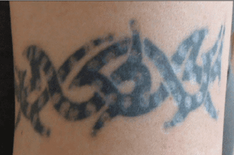 Black tribal-style tattoo healing with visible ink disruption during non-laser tattoo removal.