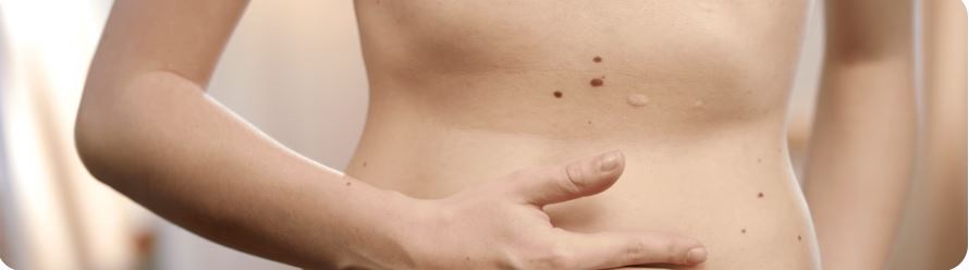 Paciente con hinchazón abdominal asociada al SIBO