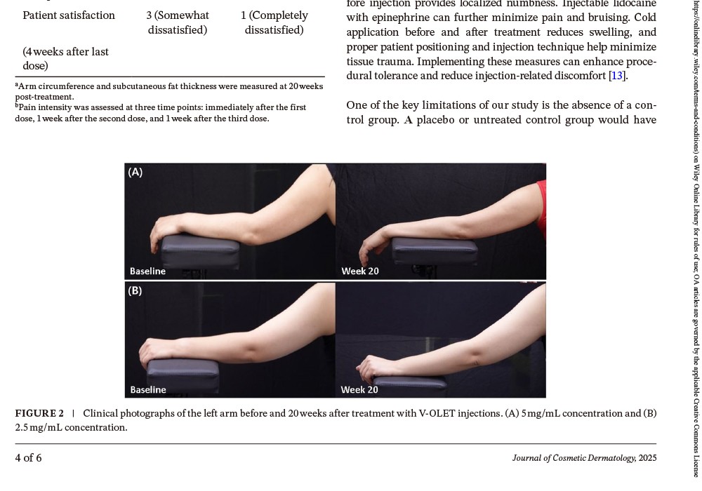 V-OLET injections provide significant arm fat reduction.