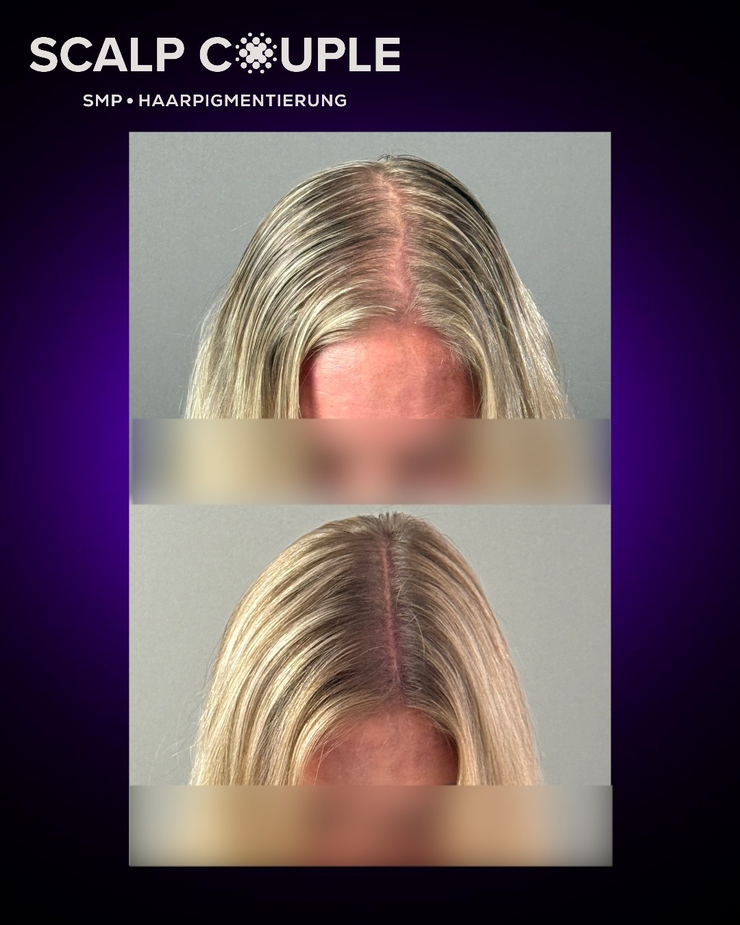 Haarpigmentierung Frau Vorher Nachher – SMP Ergebnis | Scalp Couple