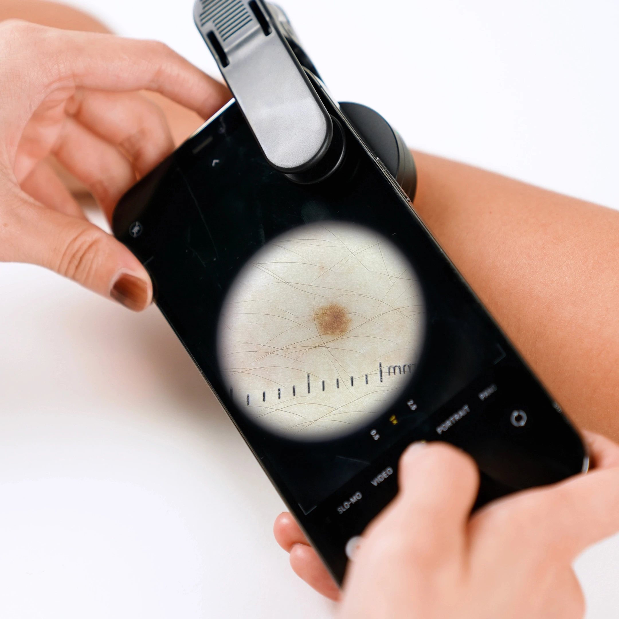 Jeskin Lens checking a mole on forearm