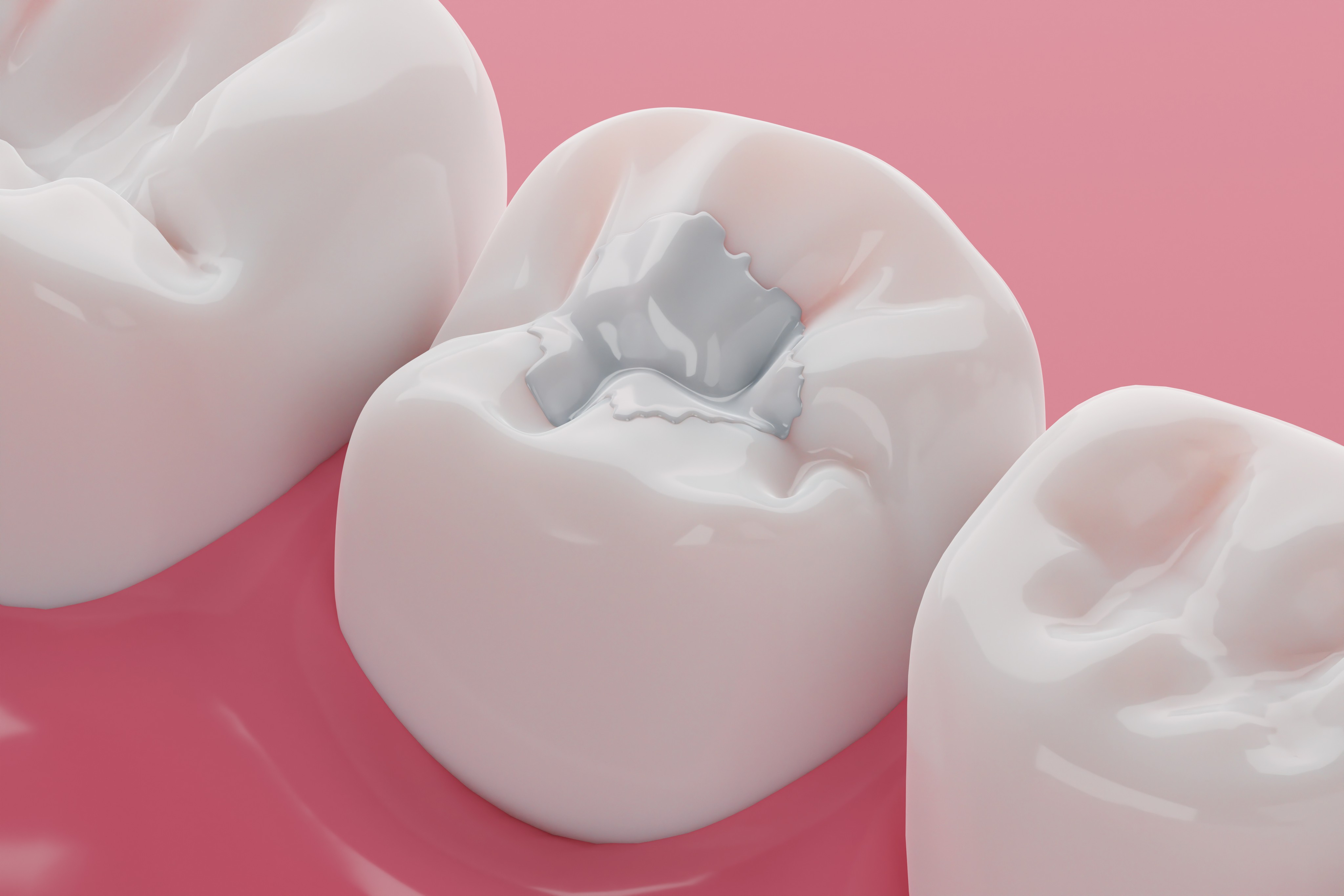 A detailed 3D rendering of three white molars on a pink gum surface shows one tooth with a silver dental filling, illustrating dental health and cavity treatment.