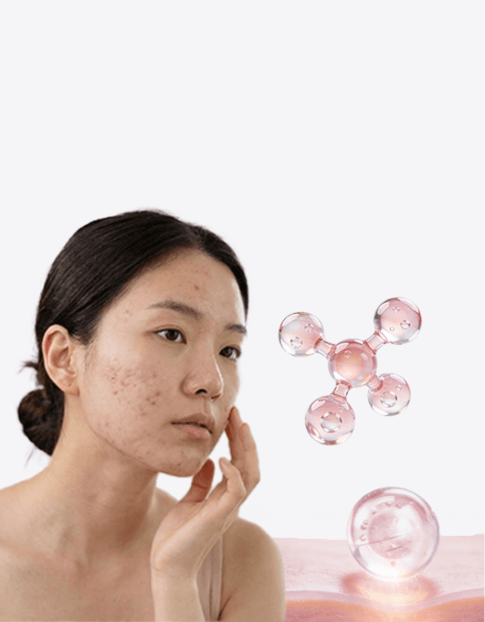 흉터는 파여있다면 세포를 수복해야 합니다 쥬베룩의 PDLLA | 홍대피부과 뷰티스톤의원