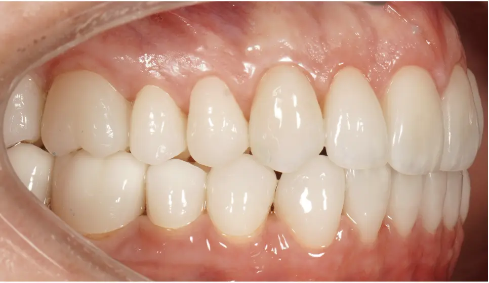 After prosthetic rehabilitation