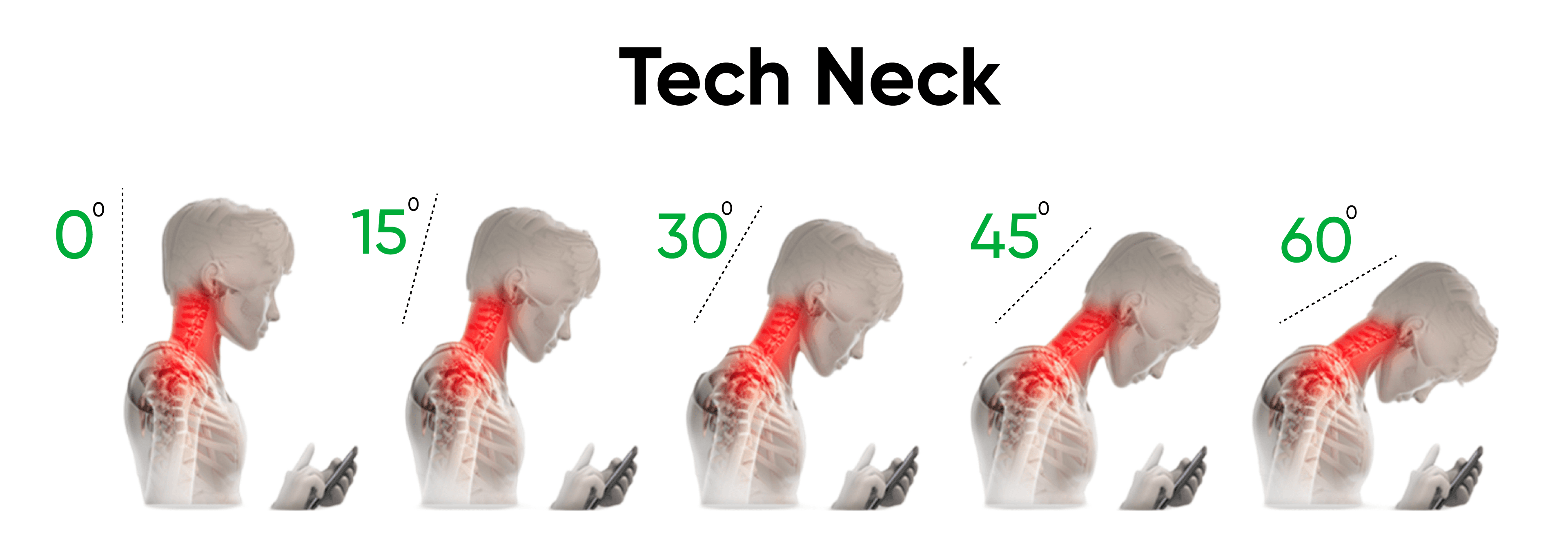 Diagram of neck strain showing 'Tech Neck' angles from 0° to 60° with red highlighted stress areas, - ech neck exercises - Posture correction tips - Stretches for neck pain relief - Neck pain from screen time - Reduce tech neck symptoms - Simple stretches for tech neck - Screen time posture solutions - Ergonomic tips for desk workers - Ease tech neck discomfort - Neck and back pain solutions - Chronic pain relief from tech use - Healthy screen time habits - Work-from-home posture tips - Prevent text neck problems - Daily stretches for neck and shoulders