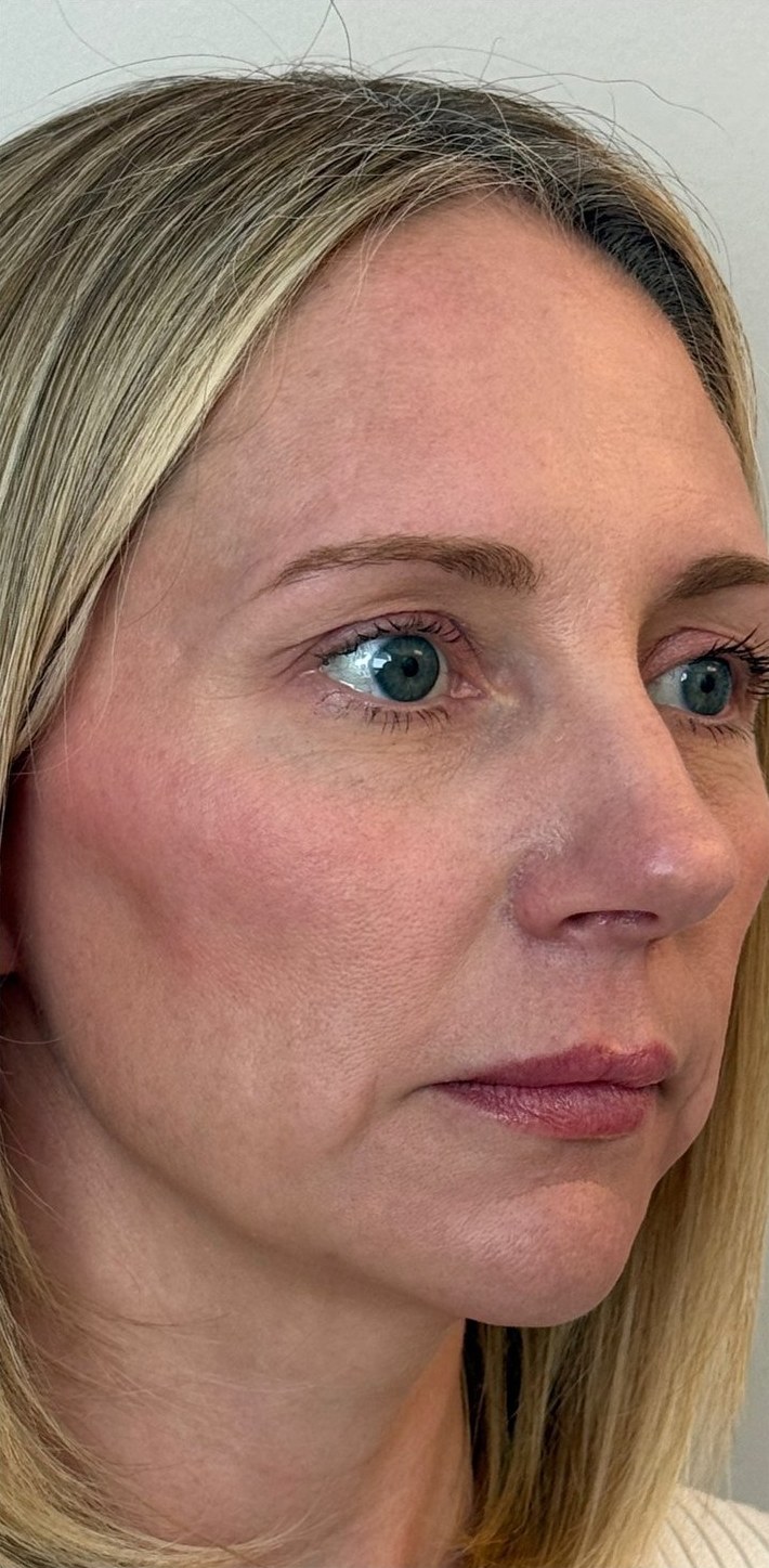 Before: a woman with blonde hair in three-quarter view.