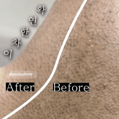 수염제모 모낭염예방 레이저 전후 관리법