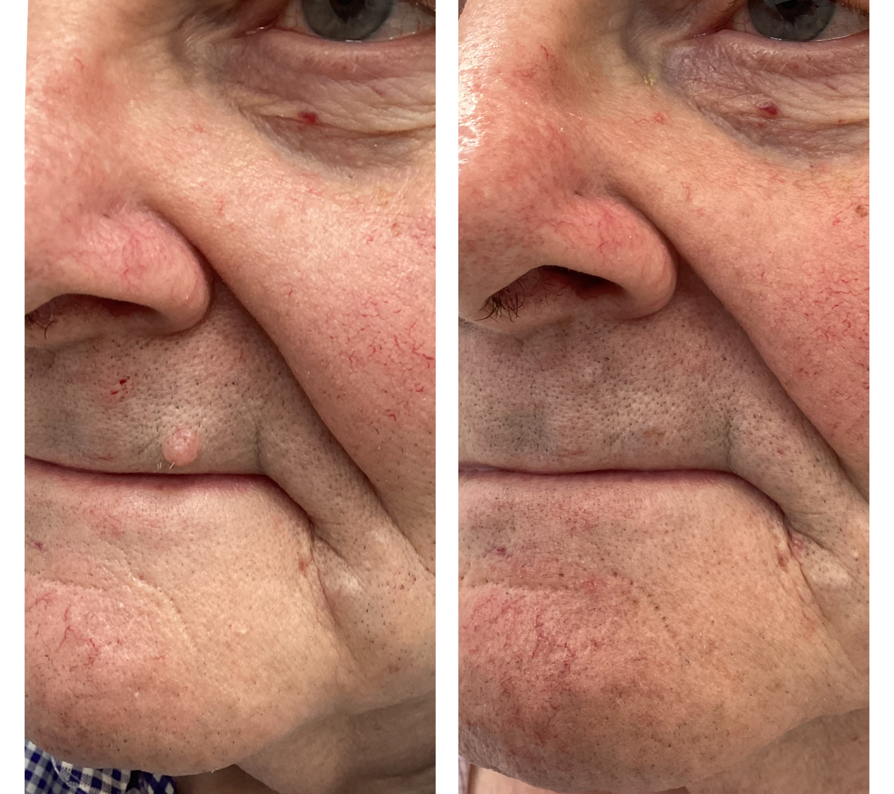 Laser treatment on woman's cheek with protective eye shield