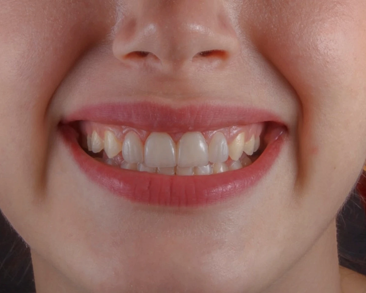 a person's mouth with teeth