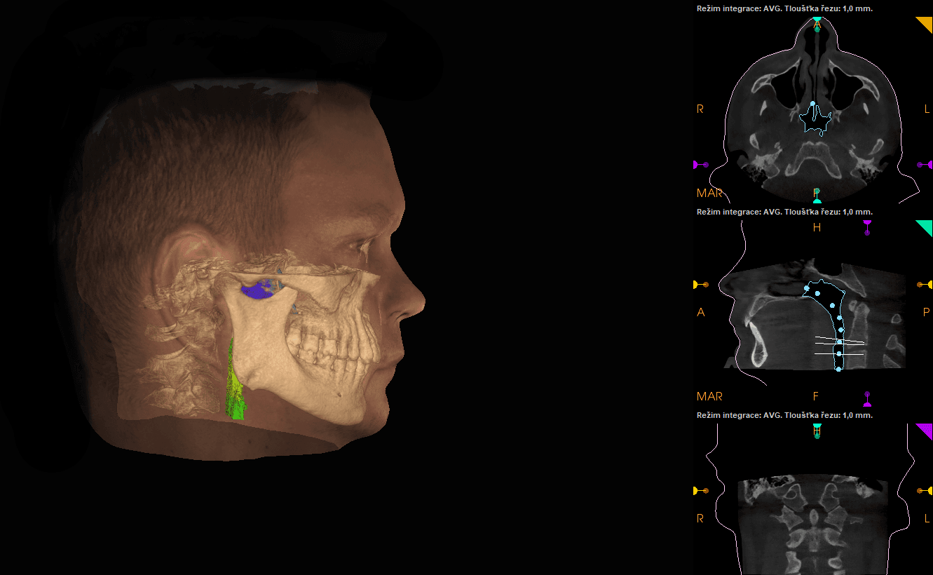 Meranie dýchacích ciest  na CBCT