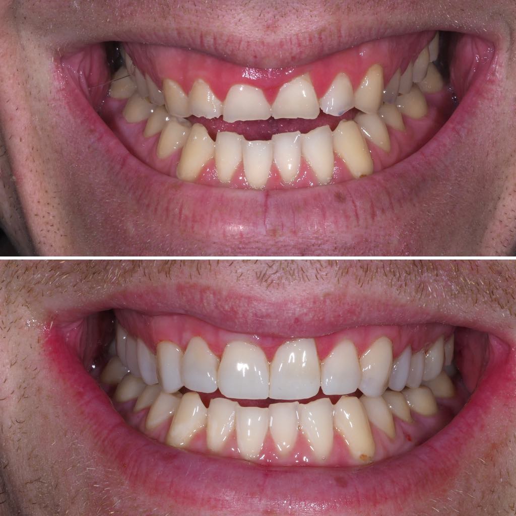 Before & After