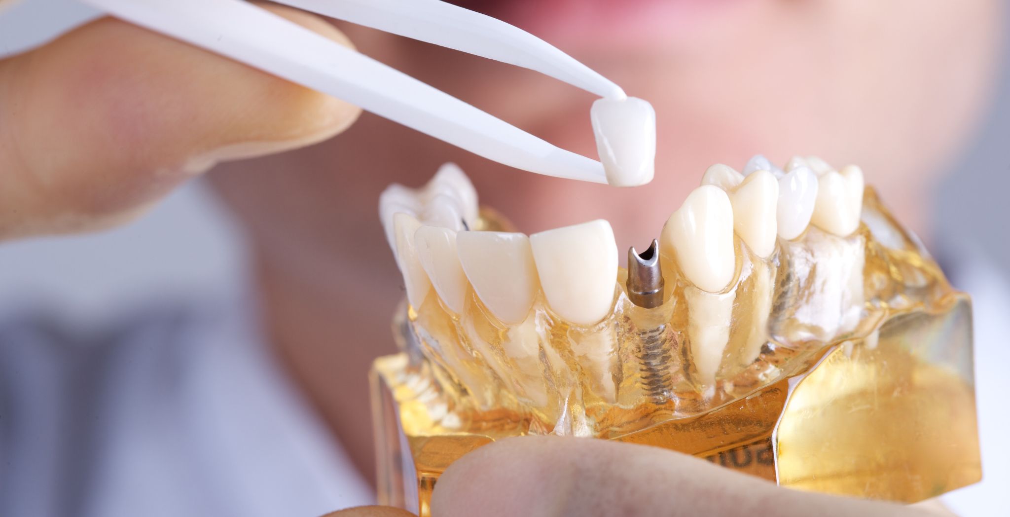dental implants