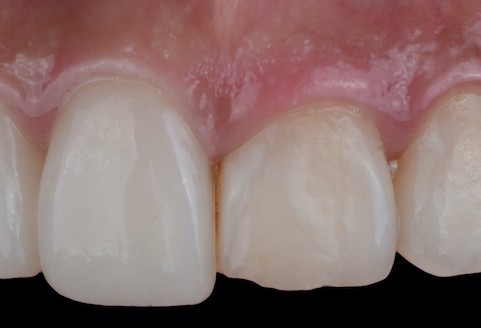 Crown Lengthening