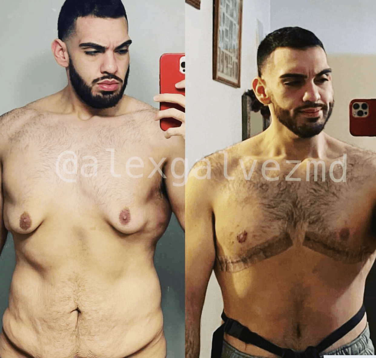 Before and after of surgery image