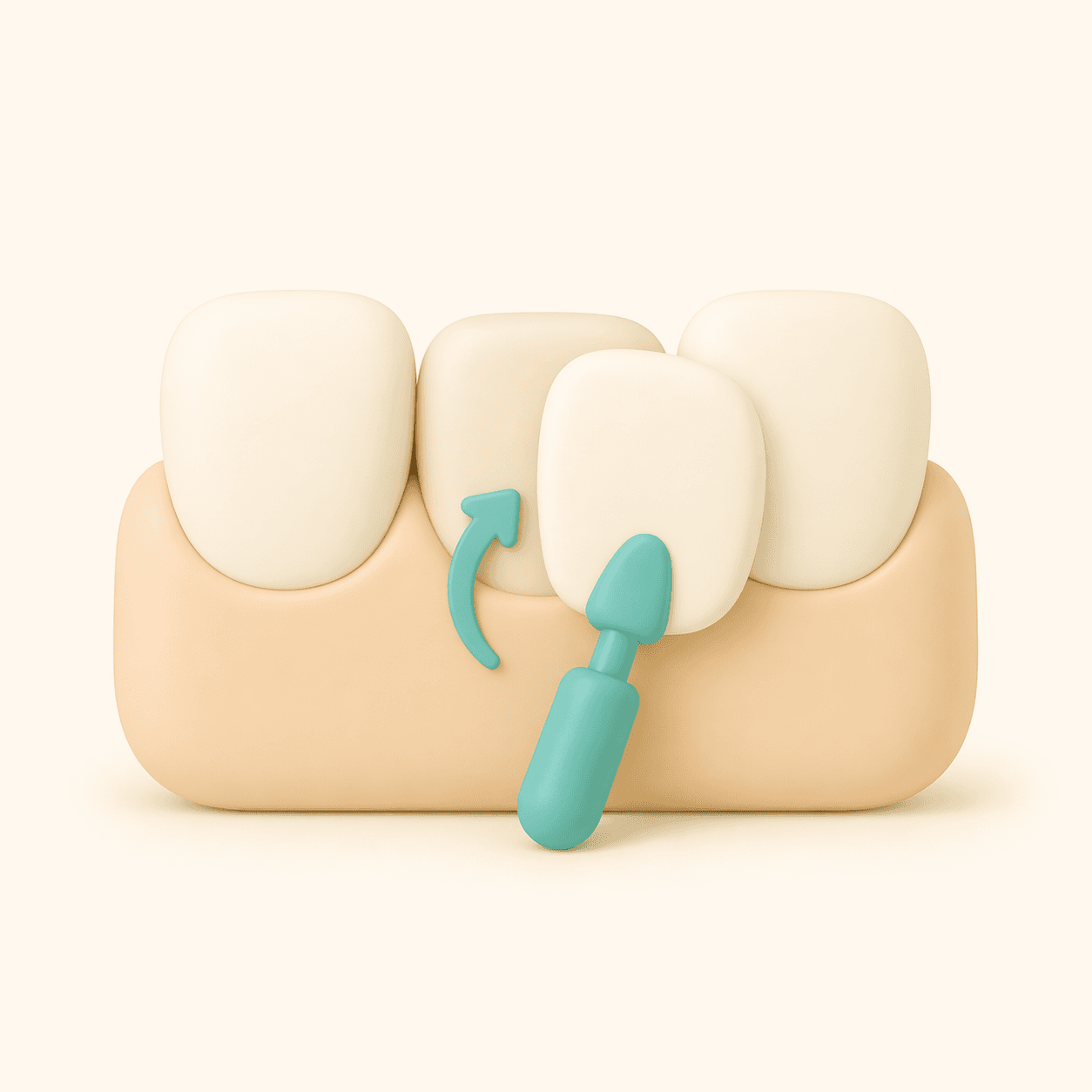 dental veneer illustration