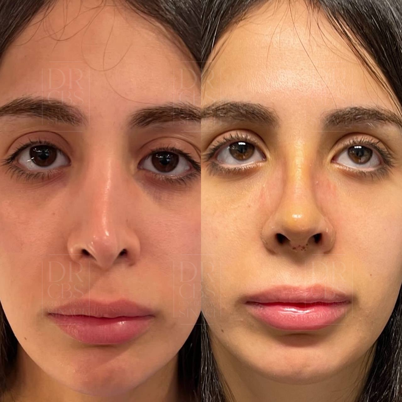 5 days before after of revision rhinoplasty after cast removal