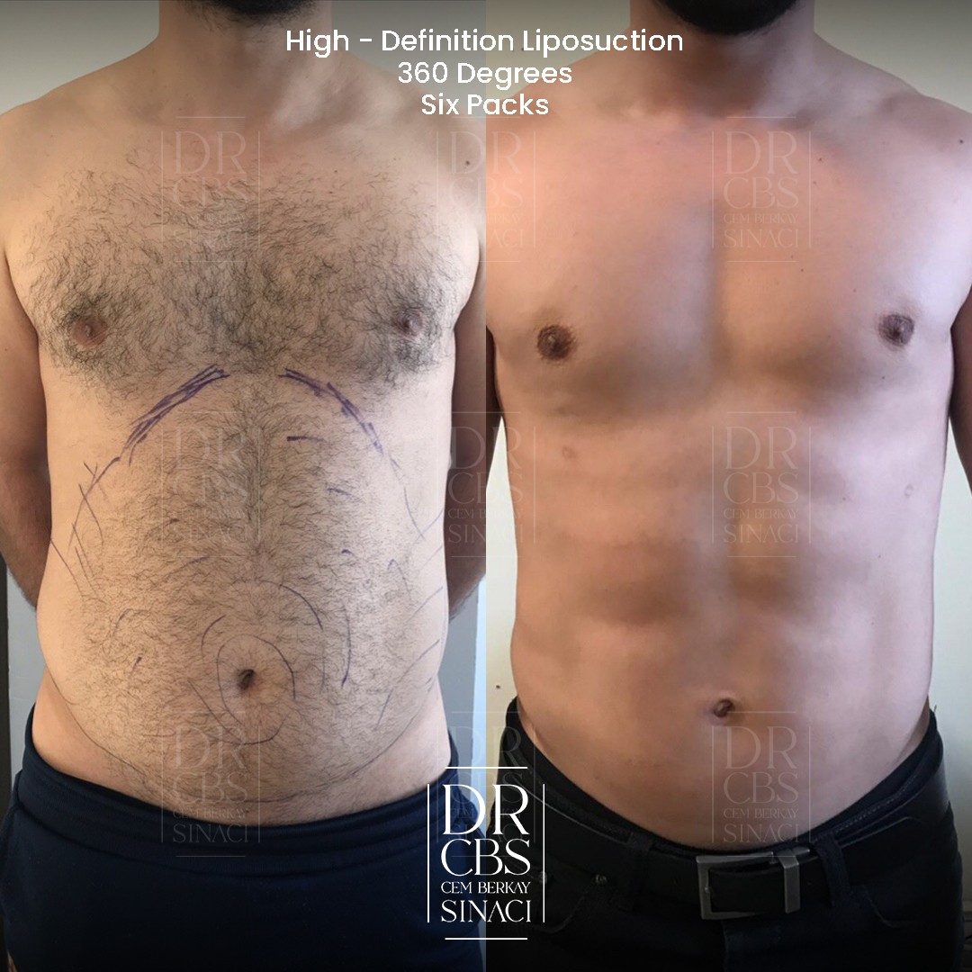 high-def liposuction before after 3 months post-op front view