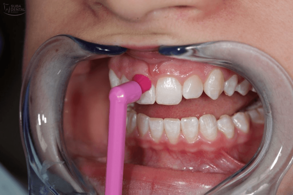 Professional dental implant cleaning