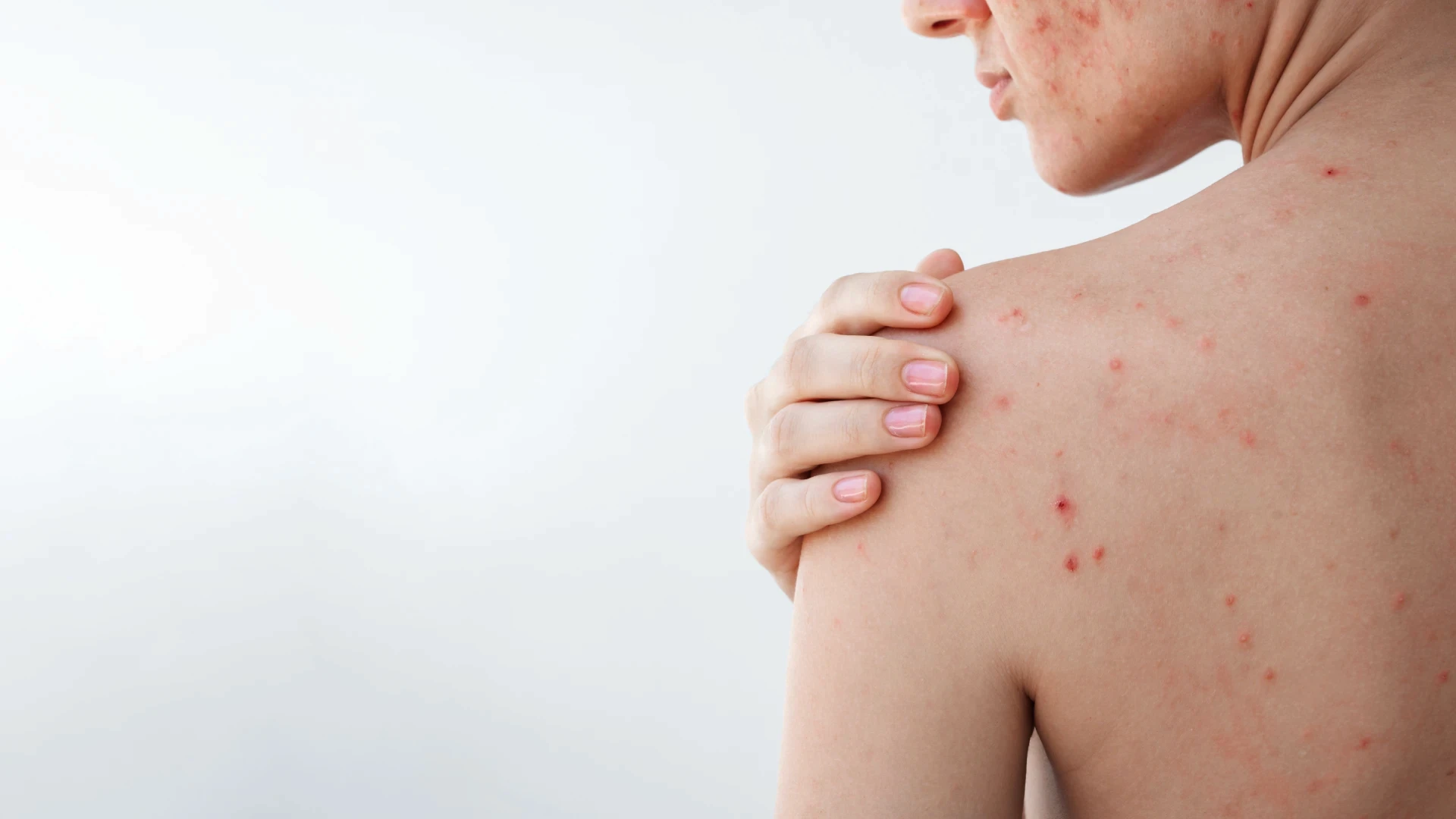 Back acne treatment in Singapore