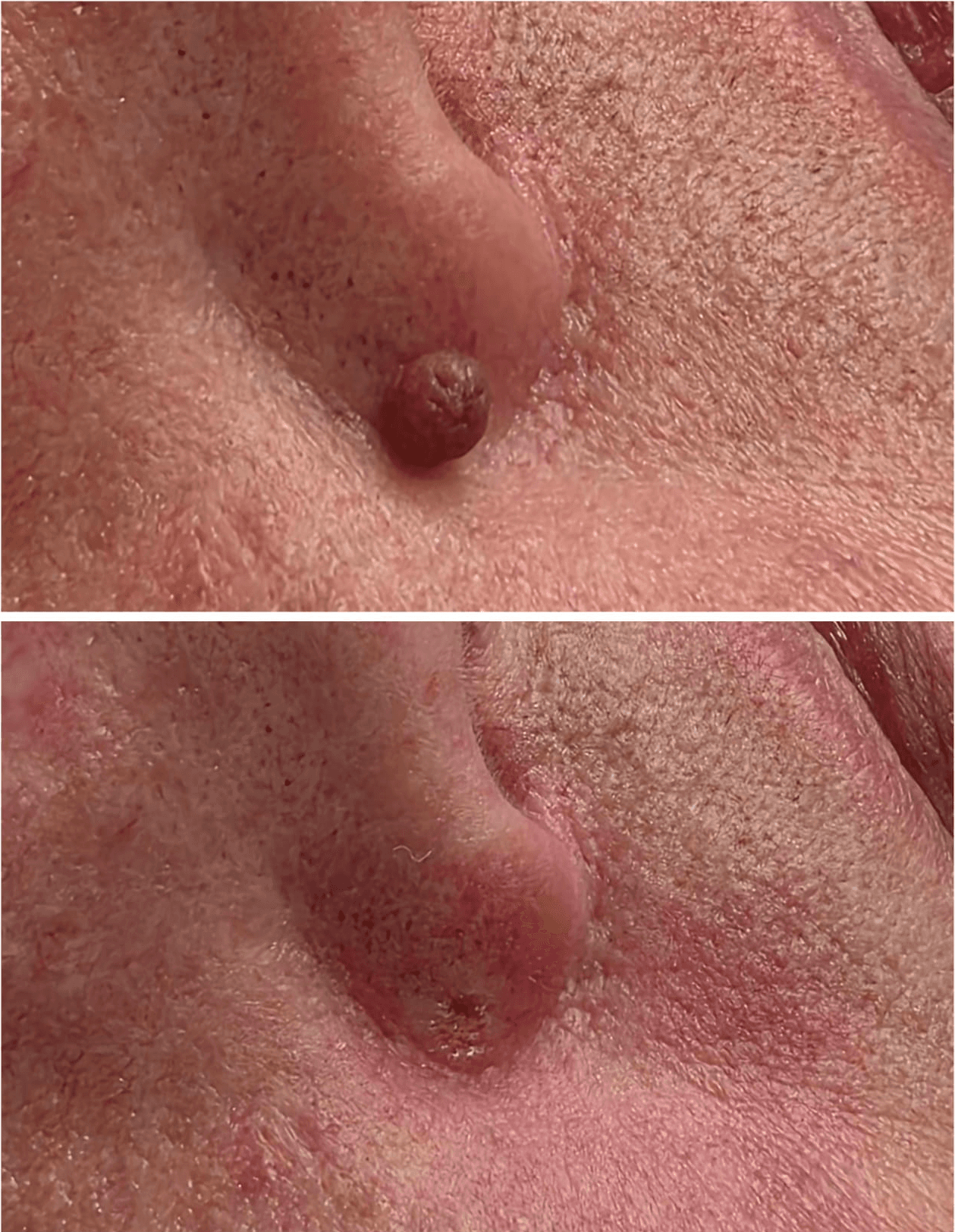 Skin tag removal in winnipeg before and after on nose