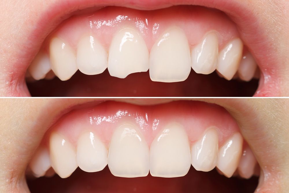veneers