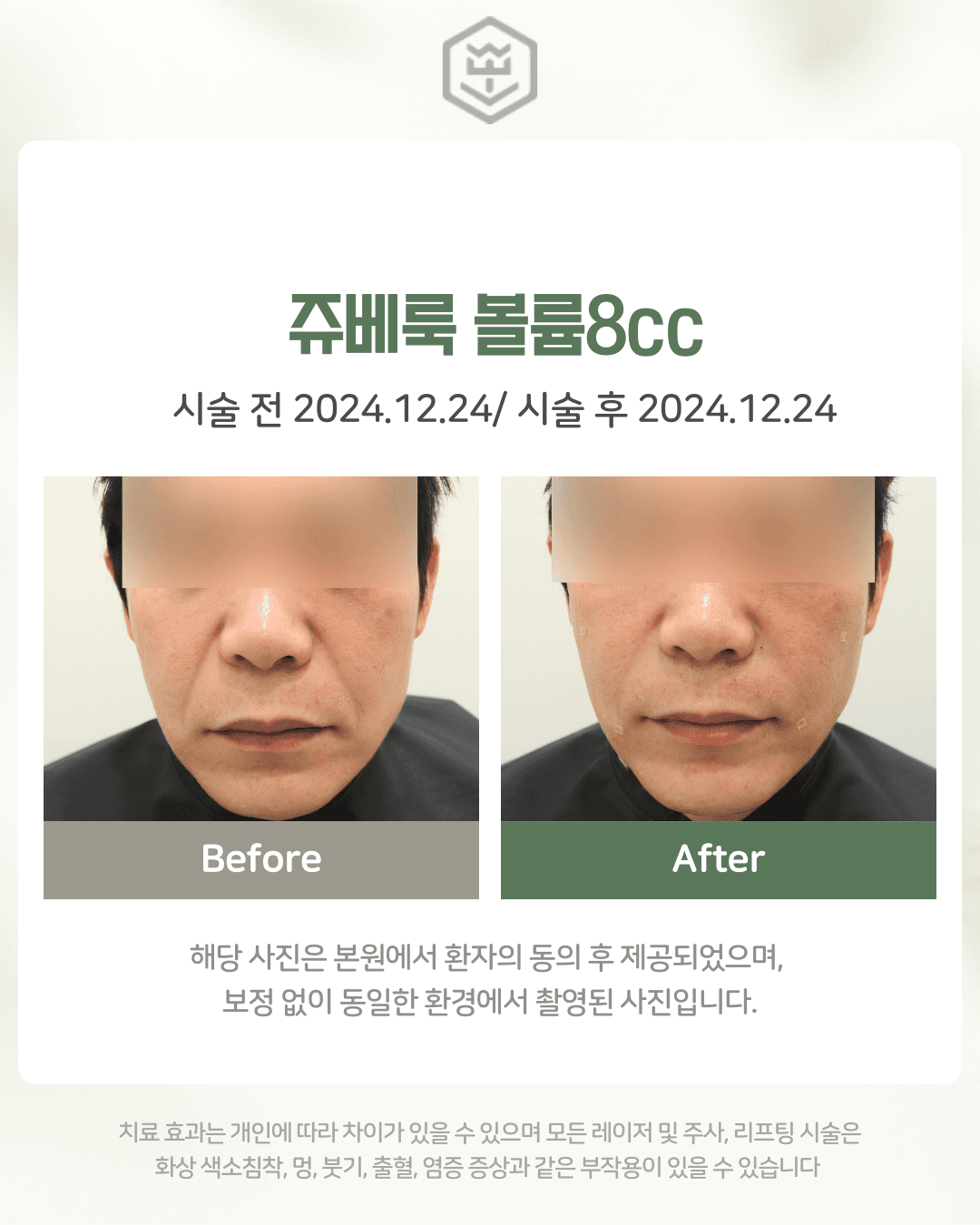 쥬베룩볼륨 8cc