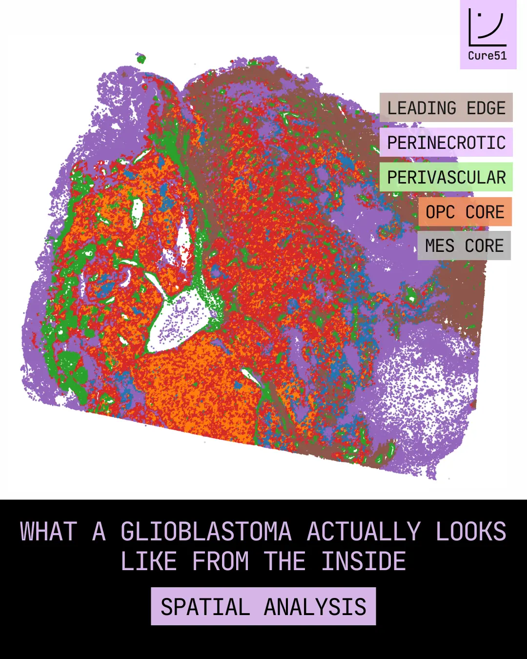 spatial-biology-glioblastoma