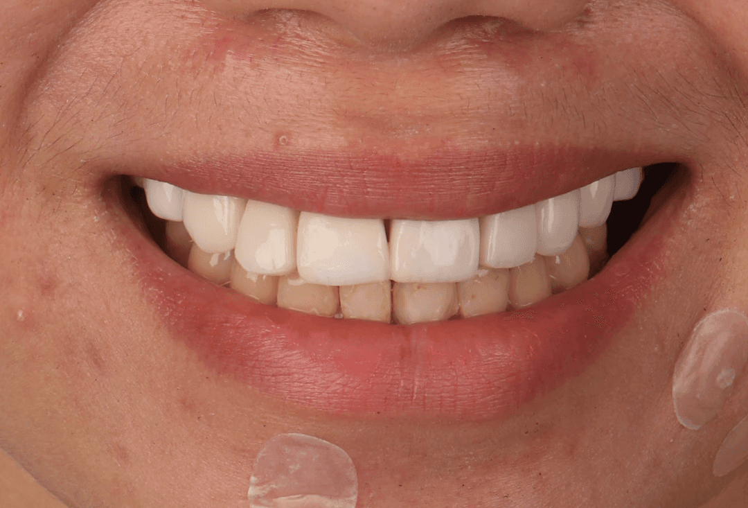 Before photo of veneer restoration case at Ora Dental showing opaque bulky veneers