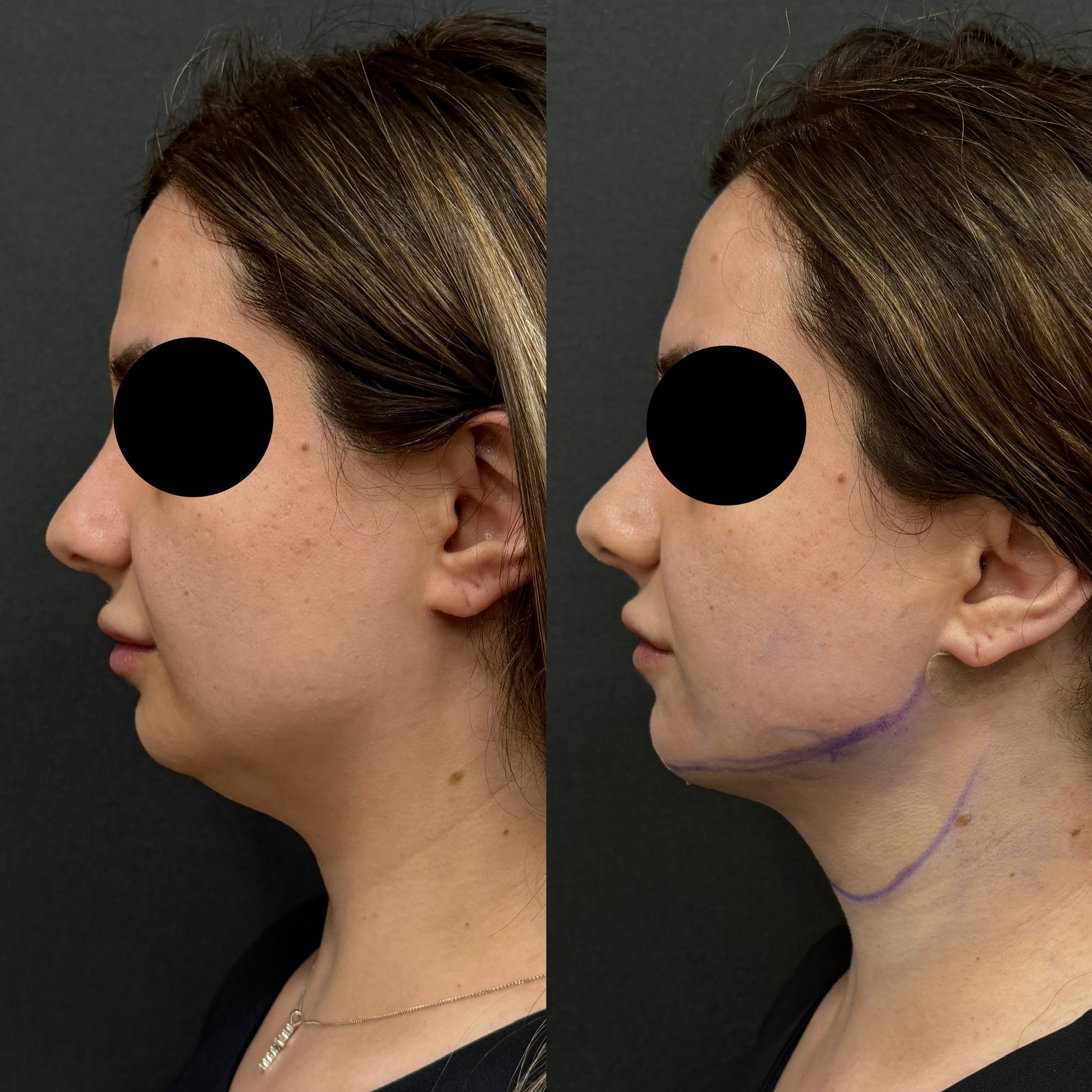 neck laser liposuction immediate post-surgery before after left side view