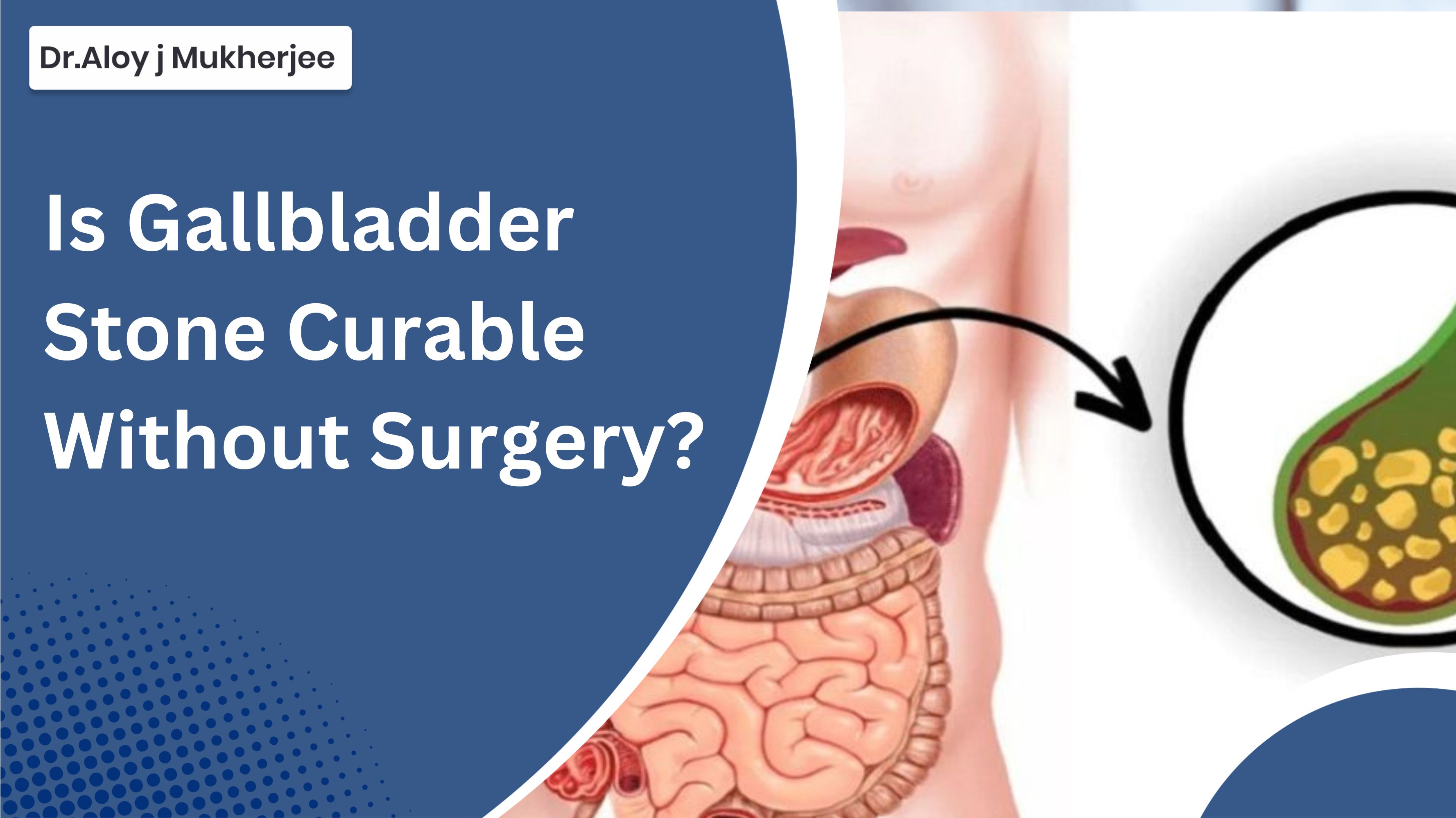 Is Gallbladder Stone Curable Without Surgery
