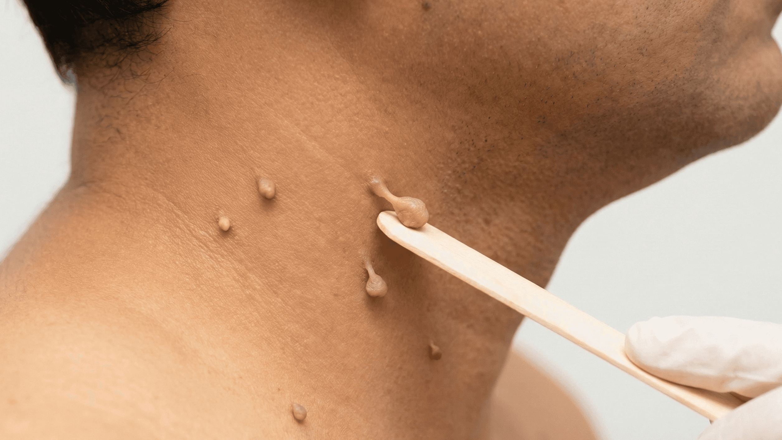 A high-resolution clinical photograph showing several small, flesh-colored skin tags on the neck of an Indian patient. The lighting is clear and professional, highlighting the pedunculated (stalk-like) nature of the growths against a warm skin tone.