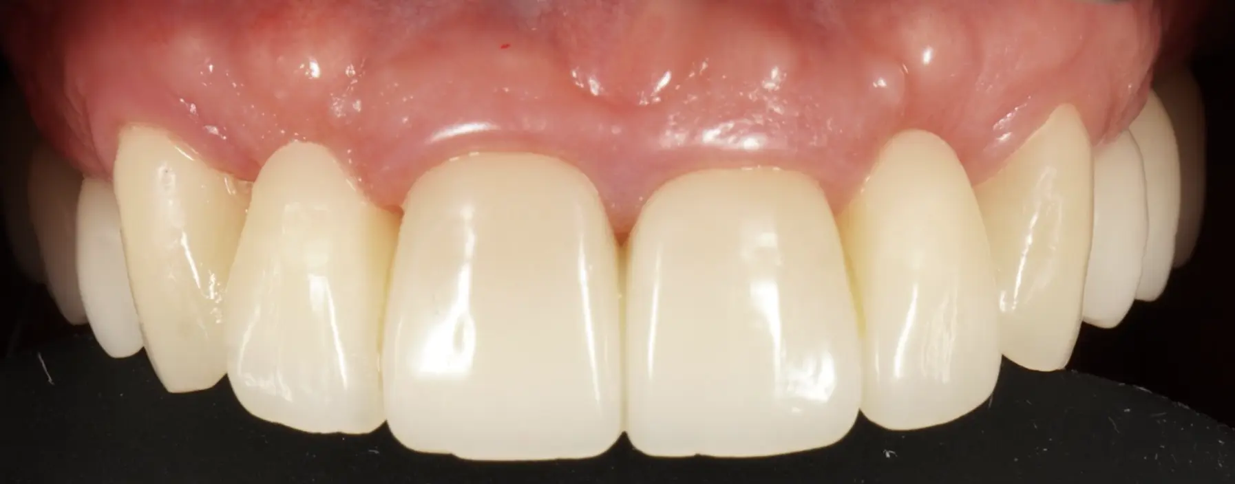 Temporary crowns on frontal teeth, changing old composite restorations (before and after)