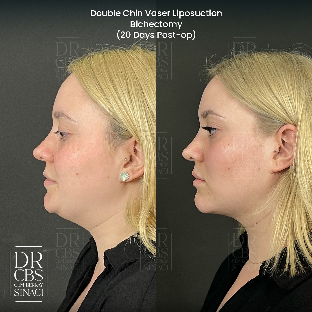 1 month post-op buccal fat removal chin lipo