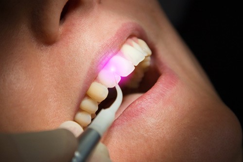 Laser Gum Surgery