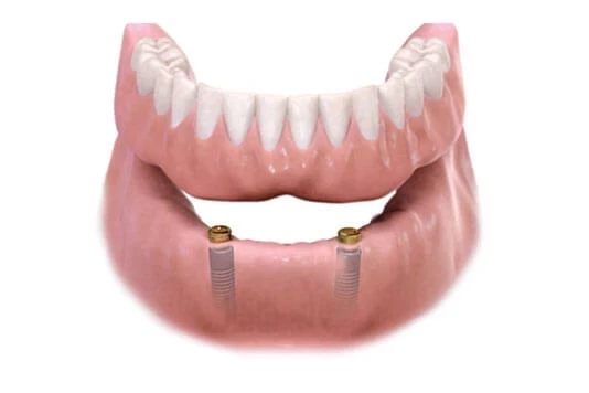 Full-Arch Dental Implants in Toronto, ON | Bloor-Yorkville Periodontics