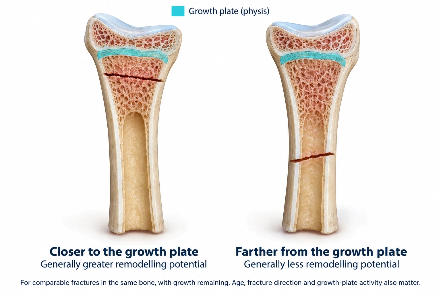 Illustration comparing a bone fracture close to the growth plate with one farther away, showing greater remodelling potential nearer the growth plate.