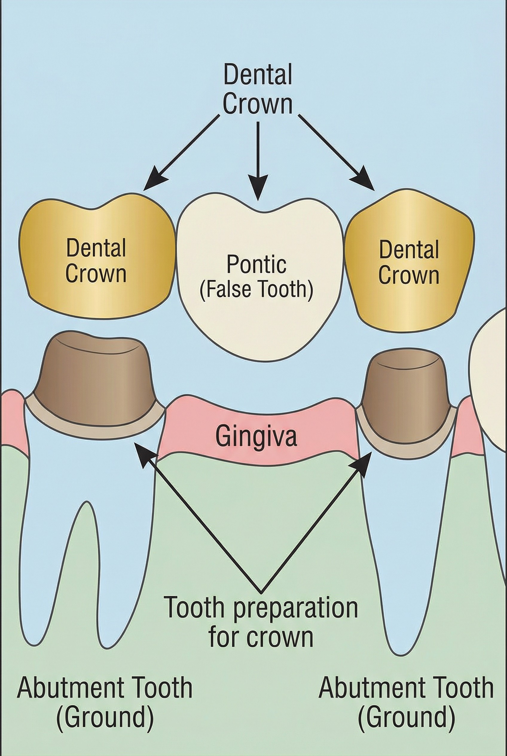 Medical illustration showing dental bridge anatomy with crowns on adjacent teeth and pontic spanning missing tooth gap