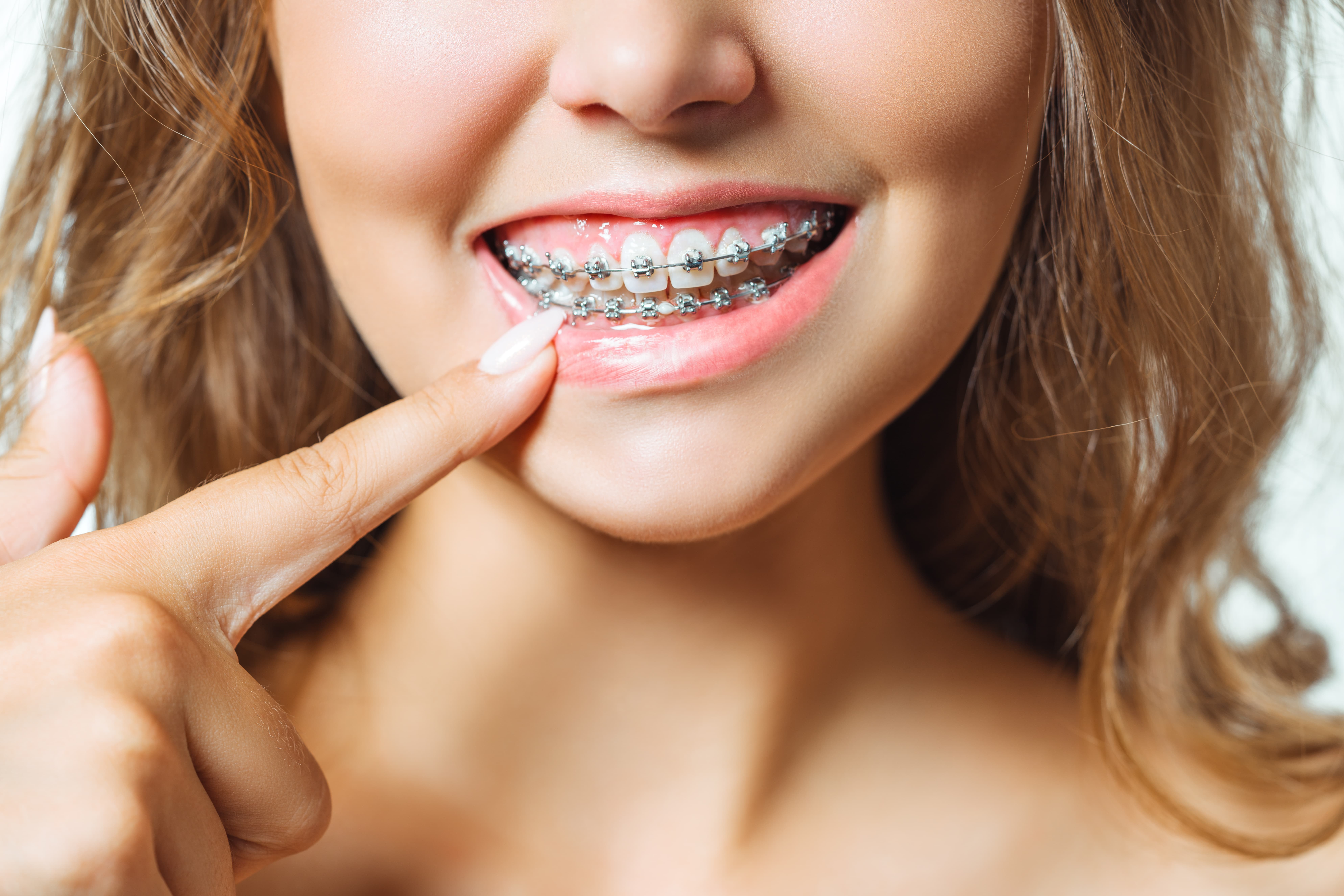 A young boy smiling with his braces