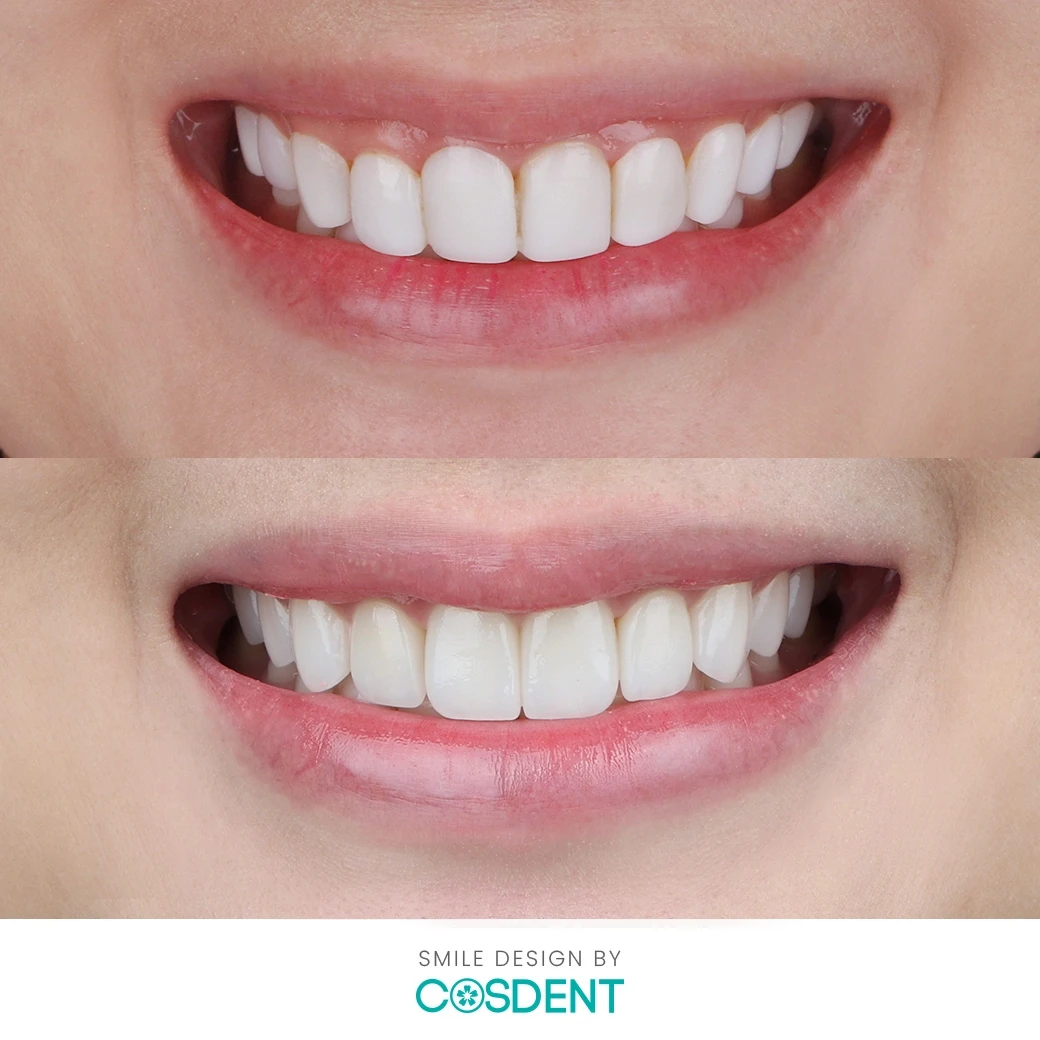 รีวิวออกแบบรอยยิ้ม ที่ cosdent smile design