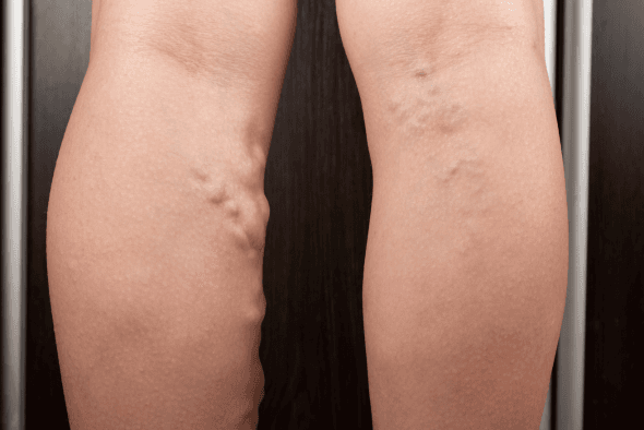 Fatores de Risco para Tromboembolismo: O Que Toda Mulher Precisa Saber