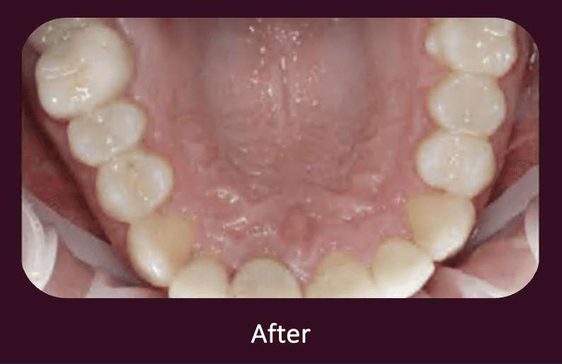 Teeth Implants