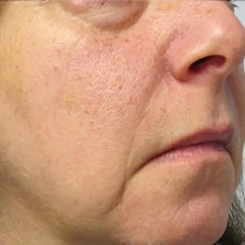 After laser rosacea treatment at The Vancouver Aesthetician — redness and rosacea completely cleared