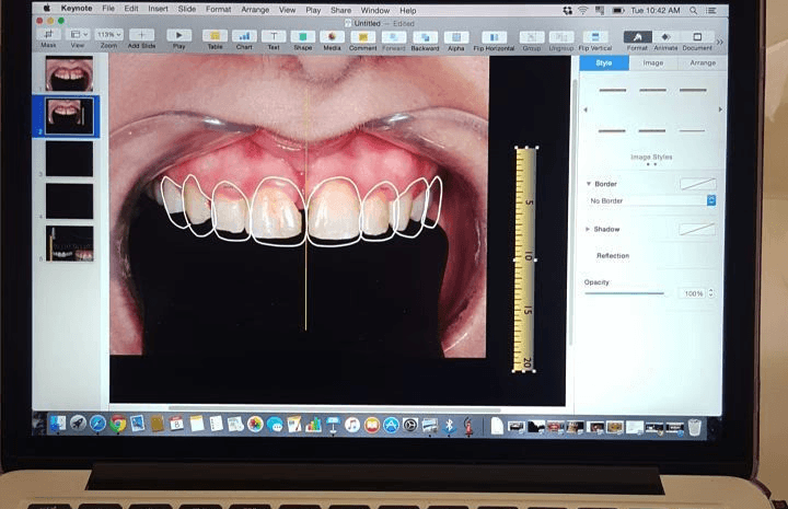 Digital Smile Design displayed on a computer screen showing veneer planning technology.